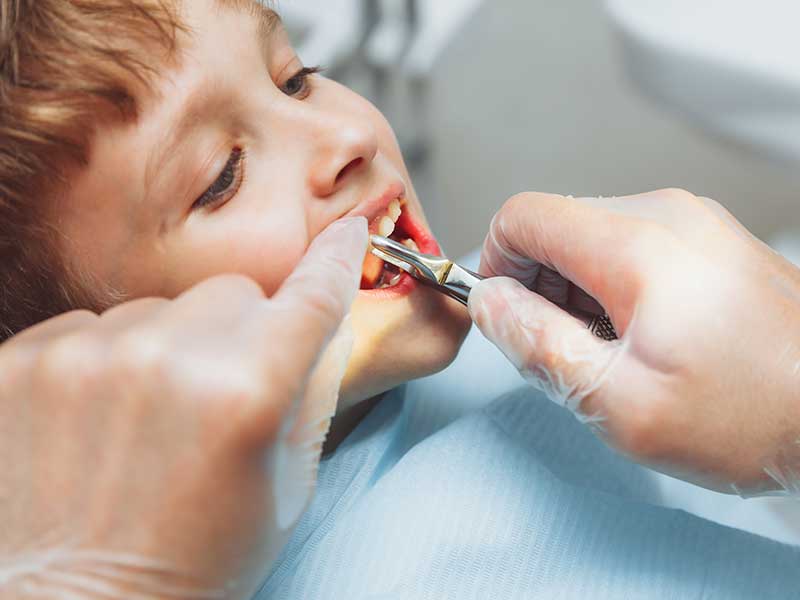 Extractions dental