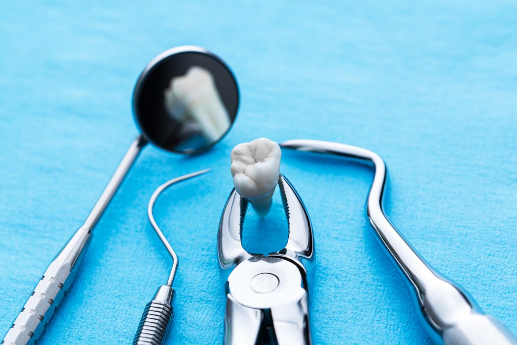 Wisdom Teeth extraction