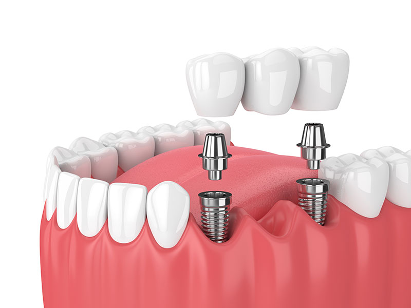 bridges dental services