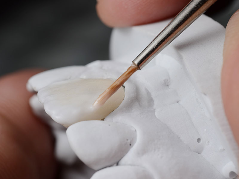 dental bonding services