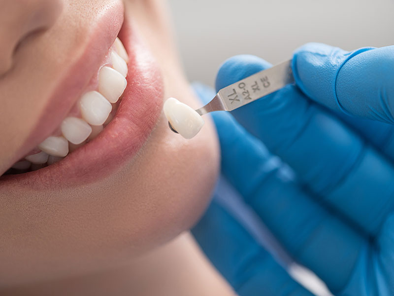 dental crowns