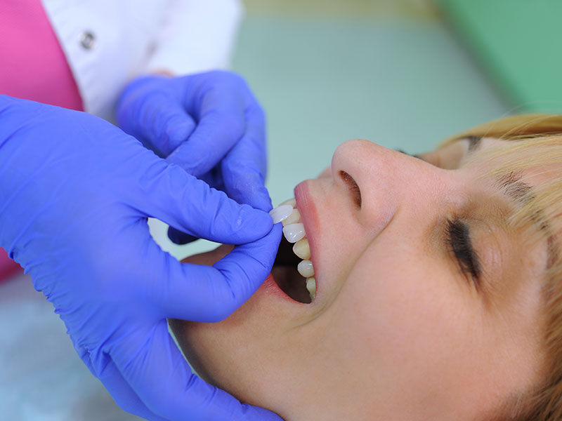 veneers dental services